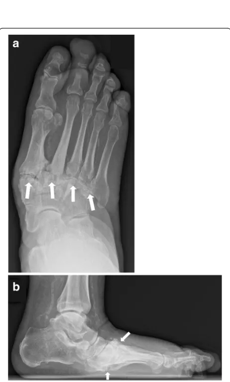 Fig. 6 Anatomical distribution in the Sanders and Frykbergclassification. Zone I: metatarsophalangeal and interphalangeal joints,zone II: tarsometatarsal joints, zone III: tarsal joints, zone IV: ankle andsubtalar joints, and zone V: calcaneus