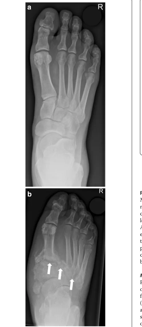Fig. 9 Weight-bearing radiograph in dp projection (5 months later). Notice the development of fractures andsubchondral cysts, erosions, joint distention, and luxation of theLisfranca baseline, b’s joint (white arrows)
