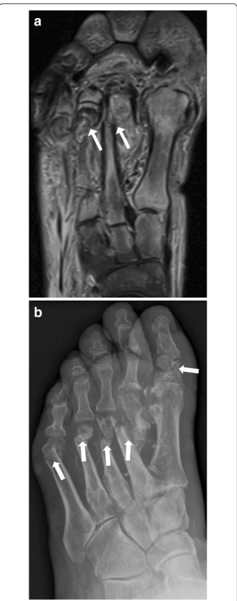 Fig. 16 Active middle-stage disease (fragmentation) of Charcot footdemonstrating gross cortical fractures of the second to fifthmetatarsal bone (white arrows) (a coronal STIR image of theforefoot, b corresponding oblique radiograph)