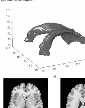 Fig. 8. An example of the MRI volume segmentation by 3-D water flow analogy: a) the water flow model segments the lateral ventricles of brain; b) – c) cross-sections of the results  