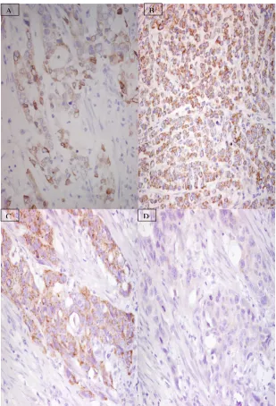 Figure 1Representative examples of COX-2 immunhistochemistry in adenocarcinoma of oesophaguslevel (>200)of COX-2 expression