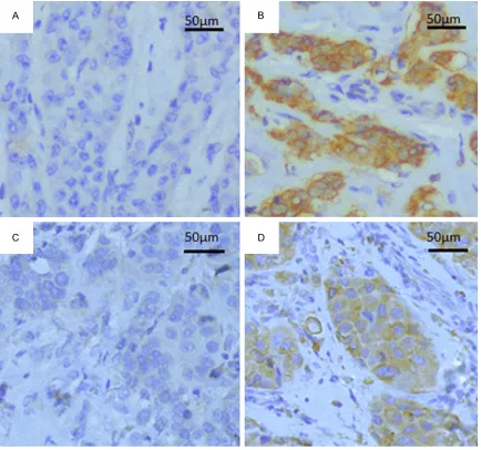 Figure 2. Immunohistochemical staining for PKM2 and VEGF-C expression in breast invasive ductal carcinoma