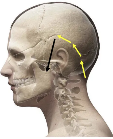 Figure 3 Postoperative radiograph: peripheral nerve ﬁeld stimulation (PNFS) in theanterior auricular region showing the position of the electrode (black arrow).