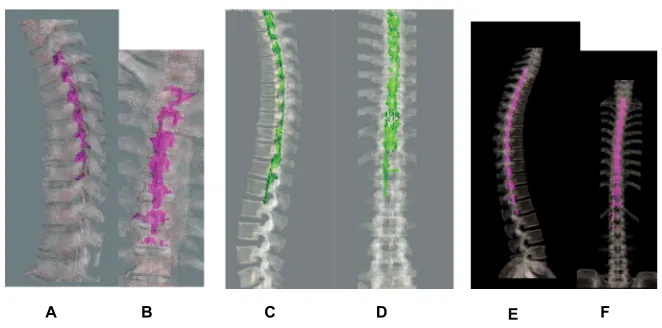 Figure 1 3D-CT in the lateral and posterior views following continuous epidural contrast injection in three cases.2