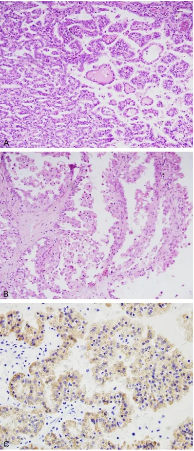 Figure 1. Microscopic and immunohistochemical findings in PRCC. A. Type 1 PRCC was papillae cov-ered by small tumor cells with scanty and basophilic cytoplasm and round nucleus, arranged in a single layer on papillary basement membrane