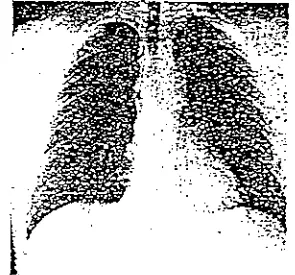 Fig. 1-4 Typical chest x-ray radiograph 
