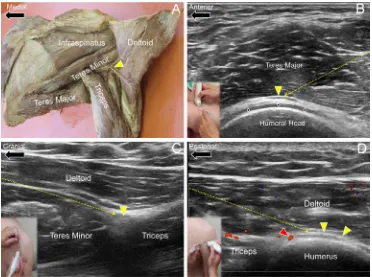 Figure 6 Ultrasound guided injection for the axillary nerveNotes: (A) Cadaver model of the axillary nerve (yellow arrowhead) at the posterior aspect of the shoulder