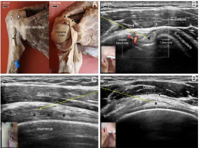 Figure 1 Ultrasound guided injection for the long head of the biceps tendonascending branch of the anterior humeral circumflex artery