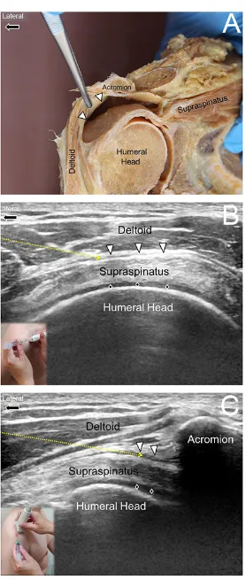 Figure 3 Ultrasound guided injection for the subdeltoid-subacromial bursabursa (white arrowheads) along the short axis of the supraspinatus tendon