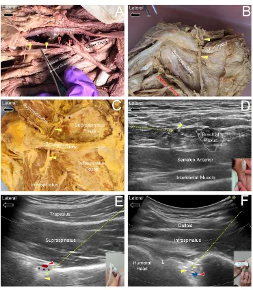 Figure 5 Ultrasound guided injection for the suprascapular nerveapproach to the suprascapular nerve (yellow arrowhead) at the supraspinatus fossa level