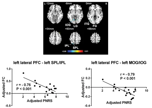 Figure S2 Brain areas whose FC with the left lateral PFC was correlated with PHN pain (with age and gender regressed out).Notes:out (correlations between the FC signal from regions of interest and pain scores.Abbreviations: Upper: brain areas whose FC with