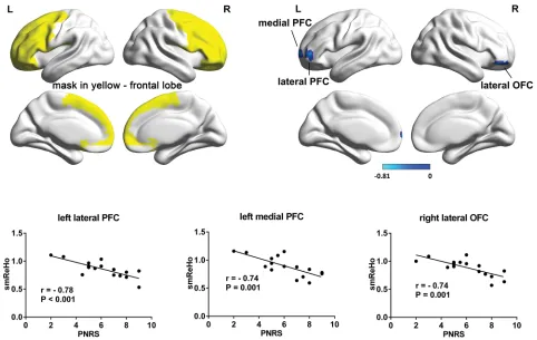 Figure 1 Frontal brain areas whose ReHo was correlated with PHN pain.and cold color indicates negative correlation