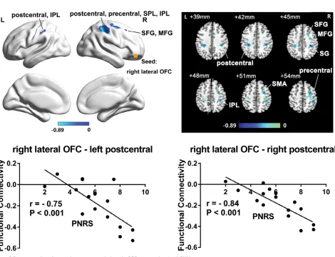 Figure 3 Brain areas whose functional connectivity with the right OFC was correlated with PHN pain.Notes: Upper: brain areas whose functional connectivity with the right lateral OFC was correlated with spontaneous pain perceived by PHN patients (P<0.05, co