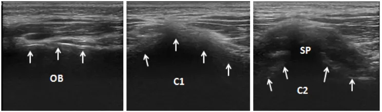 Figure 1 short-axis Us image of the cervical vertebra.Notes: the arrows indicate the bone image guided by the ultrasound.Abbreviations: C1, atlas; C2, axis; oB, occipital bone; sP, spinous process of axis; Us, ultrasound.