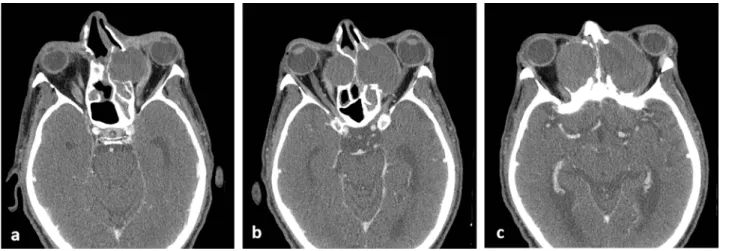 Fig. 1. Axial contrast-enhanced CT images of the sinuses and the orbit. 