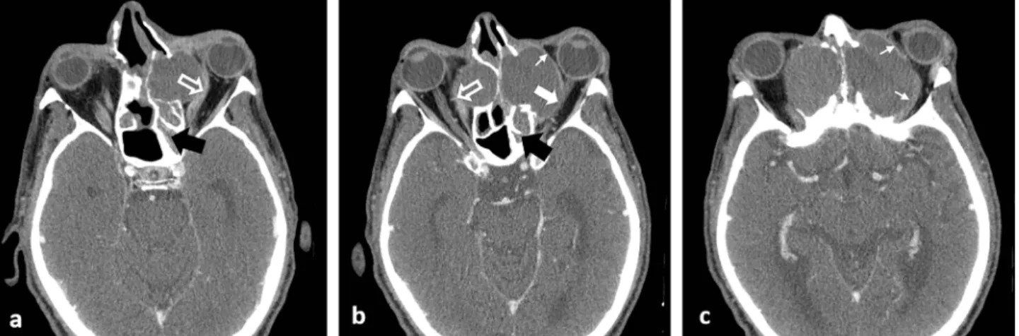 Fig. 3. a, b. Axial CT images of the frontal sinuses and c. sagittal CT reconstruction of the right frontal sinus showing thinning and  erosion of the posterior wall of the right frontal sinus and the thin enhancing periosteum (thick arrows in a-c), separa