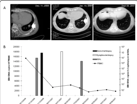 Figure 2 Kinetics of EBV DNAemia and computerizedtomography scan analysis in a patient with PTLD