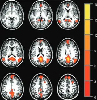 FIG 1. Representative single-participant PCC functional connectivity map, thresholded at P �.005, cluster size � 36, for an effective voxelwise P of 1 � 10�7.