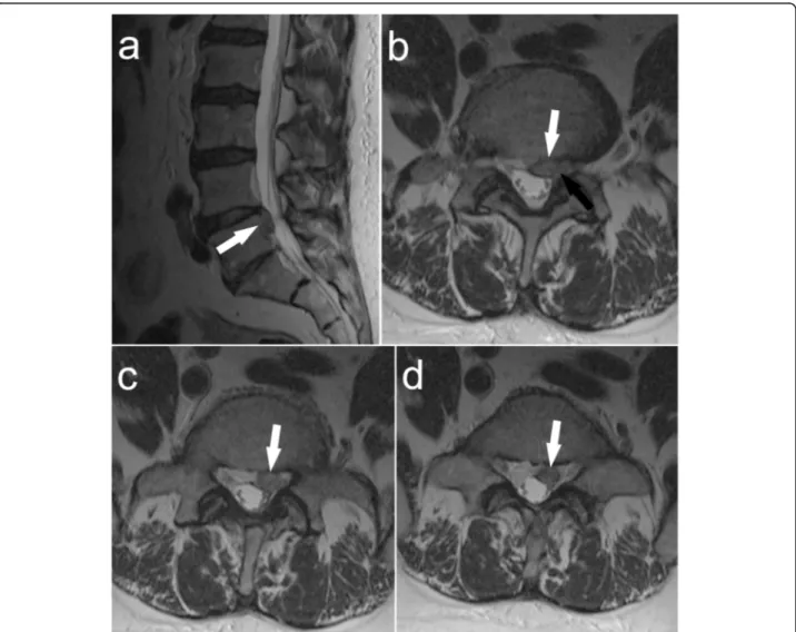 Fig. 1 Magnetic resonance imaging (MRI) presenting parasitosis of the spinal canal at L4-L5 level (white arrow) with compression of the left L5 nerve root (black arrow): a – sagittal view; b – axial view at L4-L5 level; c and d - axial view at L5 level
