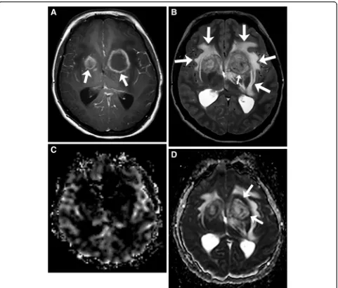 Fig. 3 Primary central nervous system post-transplant lymphoproliferative disorder. T1-weighted image with gadolinium (enhancing masses (arrows) in the basal ganglia