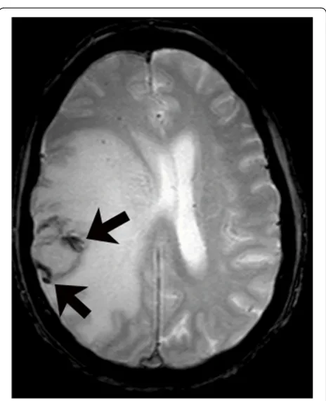 Fig. 5 Primary central nervous system lymphoma. T1-weighted image with gadolinium (a) shows two lesions with intense enhancement alongthe right lateral ventricle