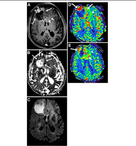Fig. 8 Glioblastoma. T1-weighted image with gadolinium (minimal decreased ADC values (arrows)