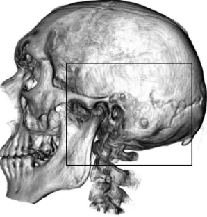 Figure 1: Surgical site. Mastoidectomy is performed in the region indicated by the rectangle in Fig