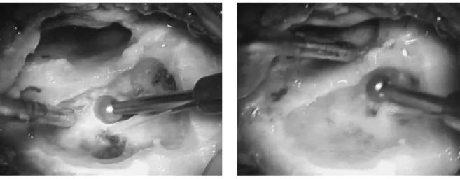 Figure 2: Operation scene. These two images are typical examples of what is seen by the surgeon while performing a mastoidectomy