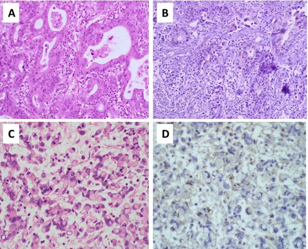 Figure 1: A-B: H&E of Moderately differentiated adenocarcinoma and corresponding IHC showing no HER2 staining on tumor cell (score-0, negative)