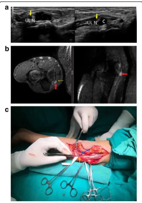 Fig. 5 a Thickened and hypoechoic ulnar nerve (U between callipers) is noted getting compressed by a cystic lesion with internal echoes (C) atthe level of cubital tunnel