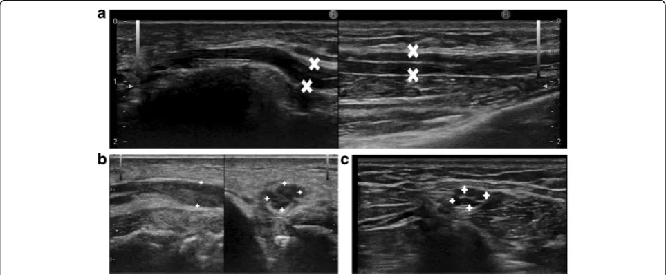Fig. 12 a Thickened, hypoechoic ulnar nerve with increased intra neural vascularity on colour Doppler, signifying ulnar neuritis
