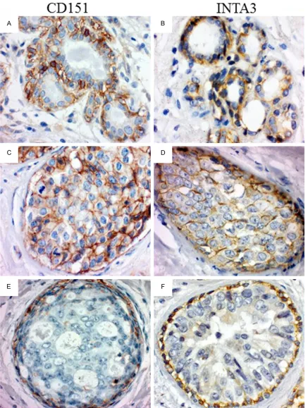 Figure 1. Expression profiles of CD151/Tspan24, INTA3. (A, B) Normal mammary gland. CD151 and INTA3 showed moderate to strong, predominantly, membranous immunoreactivity, confined to the basal and lateral surfaces of myoepithelial cells, with no or very we