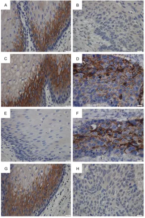 Figure 1. Immunohistochemical demonstration of claudins protein and ex-pression in human cervical carcinoma and adjacent tissue