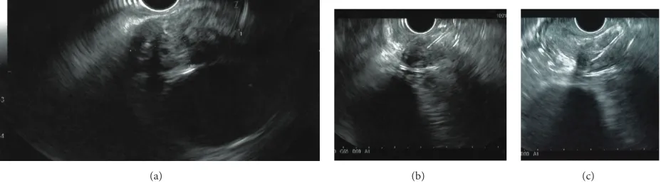 Figure 2: The fractured EUS needle visible in the esophageal lumen with a gastroscope (a)