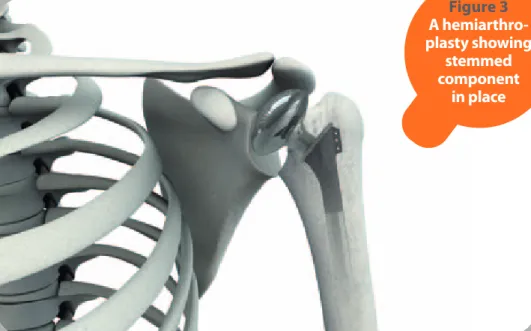 Figure 3  A  hemiarthro-plasty showing  stemmed  component  in place Figure 4  A shoulder  resurfacing  component  in place 8