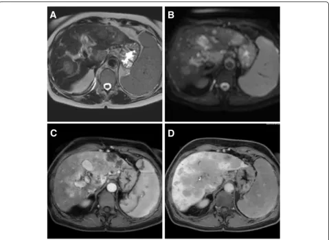 Fig. 7 Epithelioid hemangioendothelioma of the liver in a 18-year-old woman. MR images depict diffuse spread of typical EHE tumor nodulesgadoxetic acid