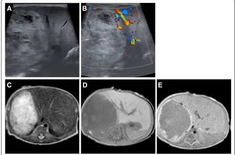 Fig. 3 Rapid-involuting hemangioma (RICH) in a newborn. Ultrasound depicted a heterogeneous, fully developed mass invading large parts ofthe right liver lobe (a) with no flow-signal on Doppler ultrasound (b)