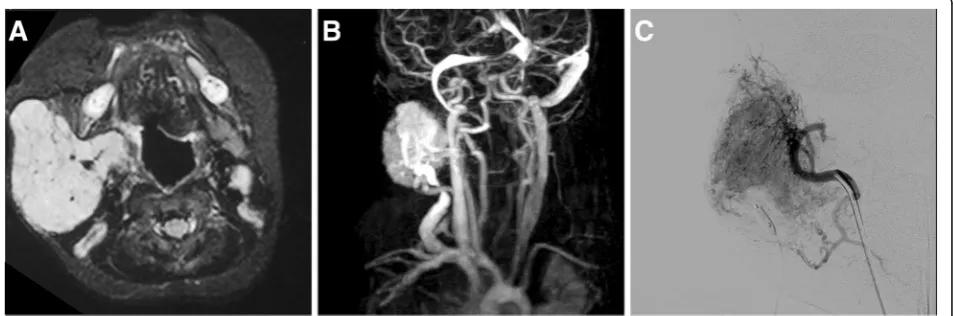 Fig. 4 Embolization therapy in large infantile hemangioma with extensive perfusion. In MRI, the hemangioma presents as a rather homogeneous,solid mass with central flow voids (a)