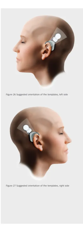 Figure 26 Suggested orientation of the templates, left sidePlace the Processor Template behind the ear and position 