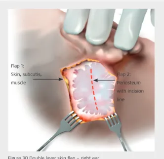 Figure 30 Double layer skin flap – right earThe incision is made and the wound is held open by retractors
