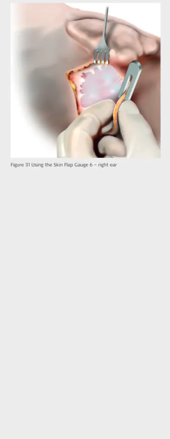 Figure 31 Using the Skin Flap Gauge 6 – right ear