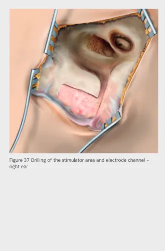 Figure 37 Drilling of the stimulator area and electrode channel –  right ear