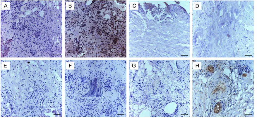 Figure 1. Immunohistochemical staining of Robo protein in human bladder cancer tissues