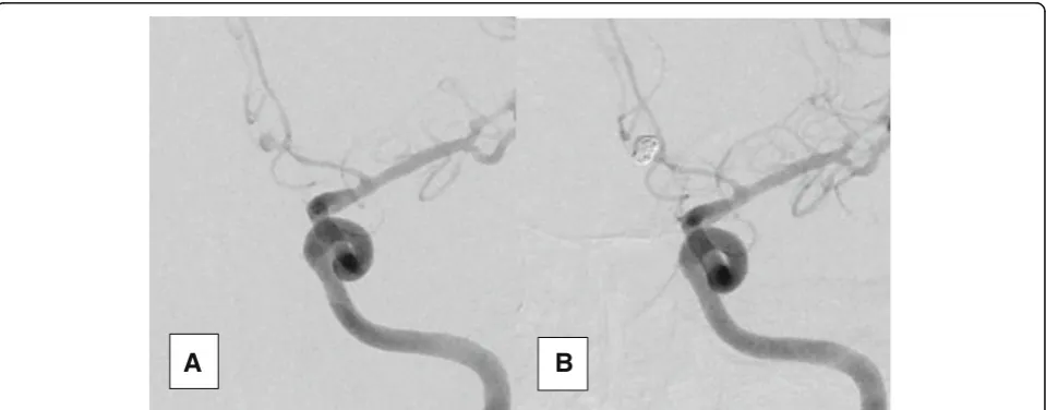 Fig. 1 A2 aneurysm before (a) and after (b) coiling showing complete obliteration (class I according to modified Raymond–Roy Classification)
