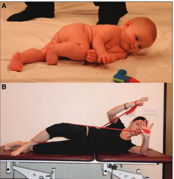 Figure 5.  (A) Rolling pattern of a 5-6 month old baby. (B) Exercise with elastic band corresponding to rolling pattern of a 5-6  month old baby.