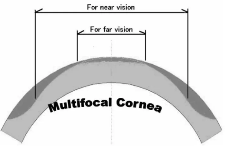 Figure  14-1.  BIFOCAL  LASER  CORRECTION  Above  is  a diagram of the design of the side view of the cornea with a bifocal laser  correction