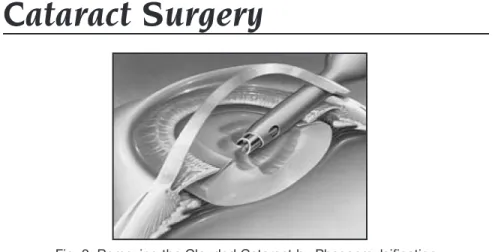Fig. 2: Removing the Clouded Cataract by Phacoemulsification
