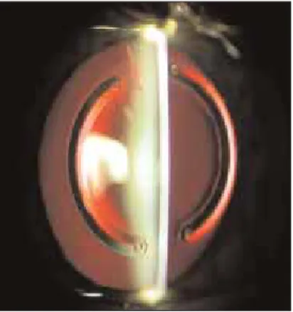Figure 1. A pair of 160° Kerarings, as seen in the eye.