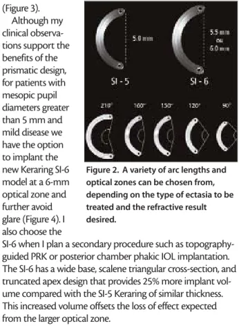 Figure 2. A variety of arc lengths and  optical zones can be chosen from, depending on the type of ectasia to be treated and the refractive result desired.