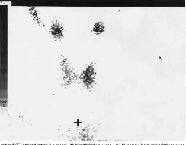 Figure 1 Reduced 99m Tc thyroid uptake in a patient with hyperthyroidism during IFNb-1b therapy (the thyroid scintiscan of the patient with overt hyperthyroidism is shown here).